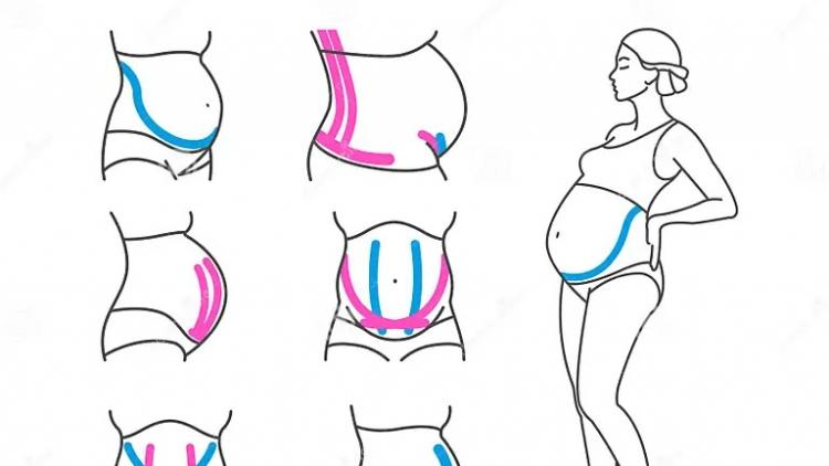 kinesio-taping-pregnant-women-kinesiology-belly-support-belt-your-design-130282993.jpg