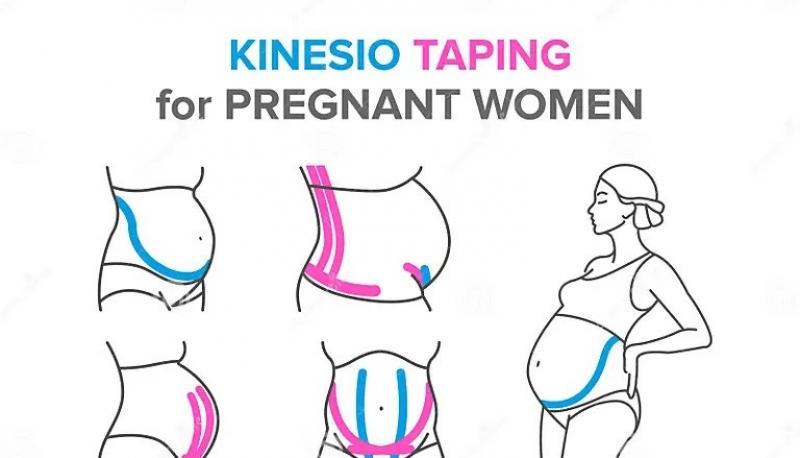 kinesio-taping-pregnant-women-kinesiology-1.jpg